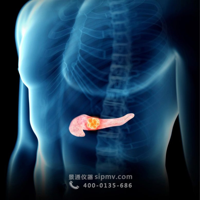 人胰腺癌插圖